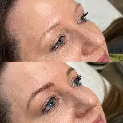 beforeafter2.jpg beforeafter2.jpg Aura Esthetics & Ink