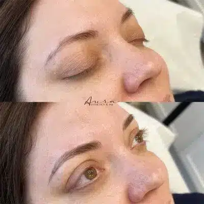 beforeafter7.jpg beforeafter7.jpg Aura Esthetics & Ink